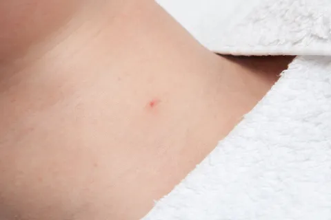 Blutschwämmchen vorher