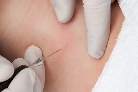 Blutschwämmchen vorher